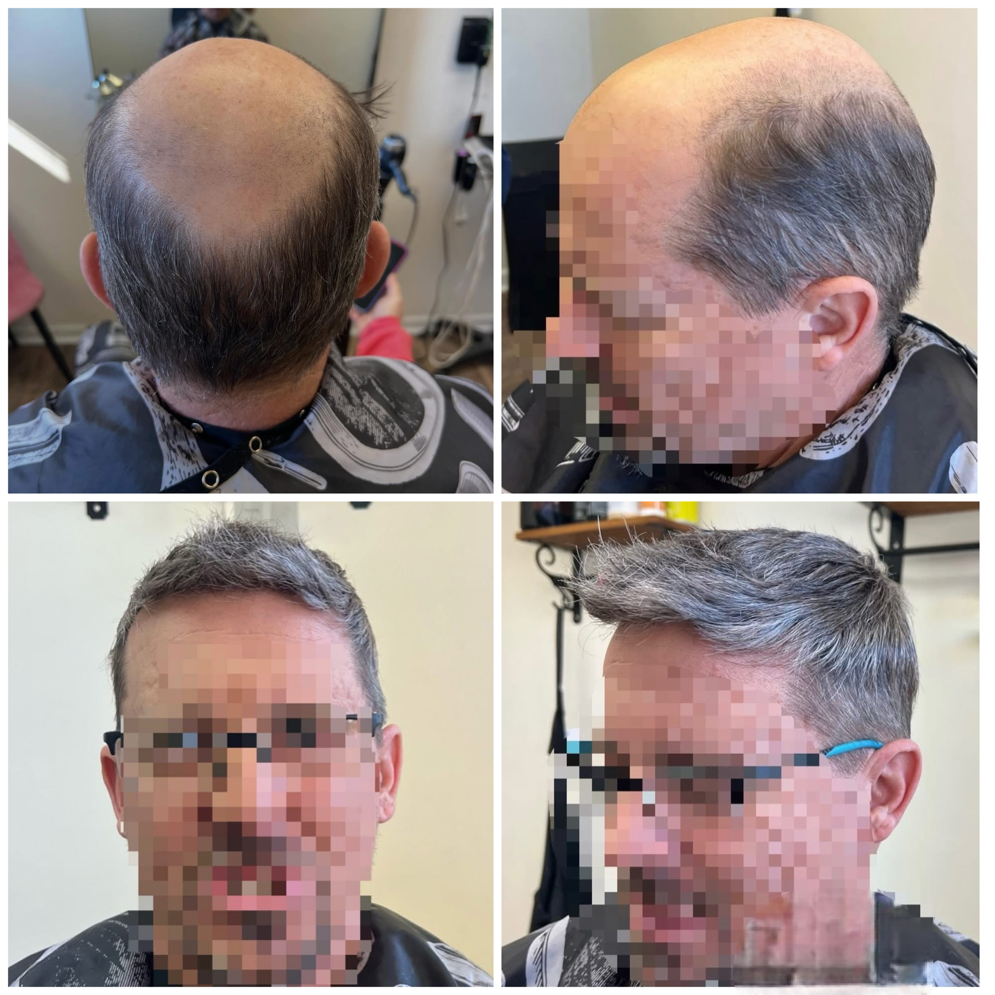 Hair Restoration